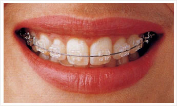 セラミックブラケット