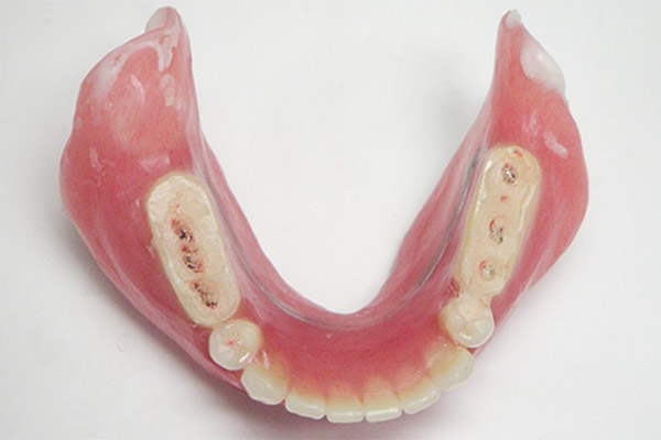 診断用義歯